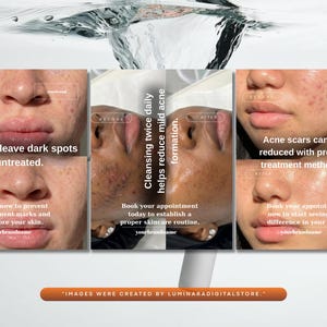 May include: A promotional image showing before and after results of skincare treatments. The image highlights the effects of acne and the benefits of a skincare routine, with text emphasizing the reduction of dark spots and acne scars.