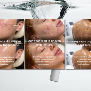 May include: A promotional image with text about acne and skincare. The image shows before and after photos of skin, along with text stating that certain foods may trigger acne and that acne can cause psychological stress.