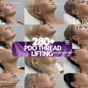 Modelos de Lifting com Fios de PDO para Canva | Posts para Instagram de Clínicas de Estética | Kit para Clínica de Estética