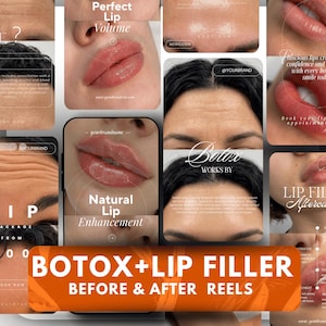 Mallar för Botox och läppfyllning, före-efter-rullar | Medspa Instagram Canva digital nedladdning