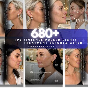May include: A promotional image displaying the effects of IPL (Intense Pulsed Light) treatment, with before and after photos. Text details the treatment and aftercare advice. The image is designed to promote skin treatment.