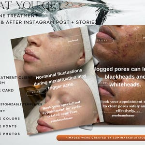 May include: A promotional image for acne treatment services. The image includes before and after photos, text about acne causes, and customizable templates. The text includes "250+ACNE TREATMENT" and "Book your appointment now".