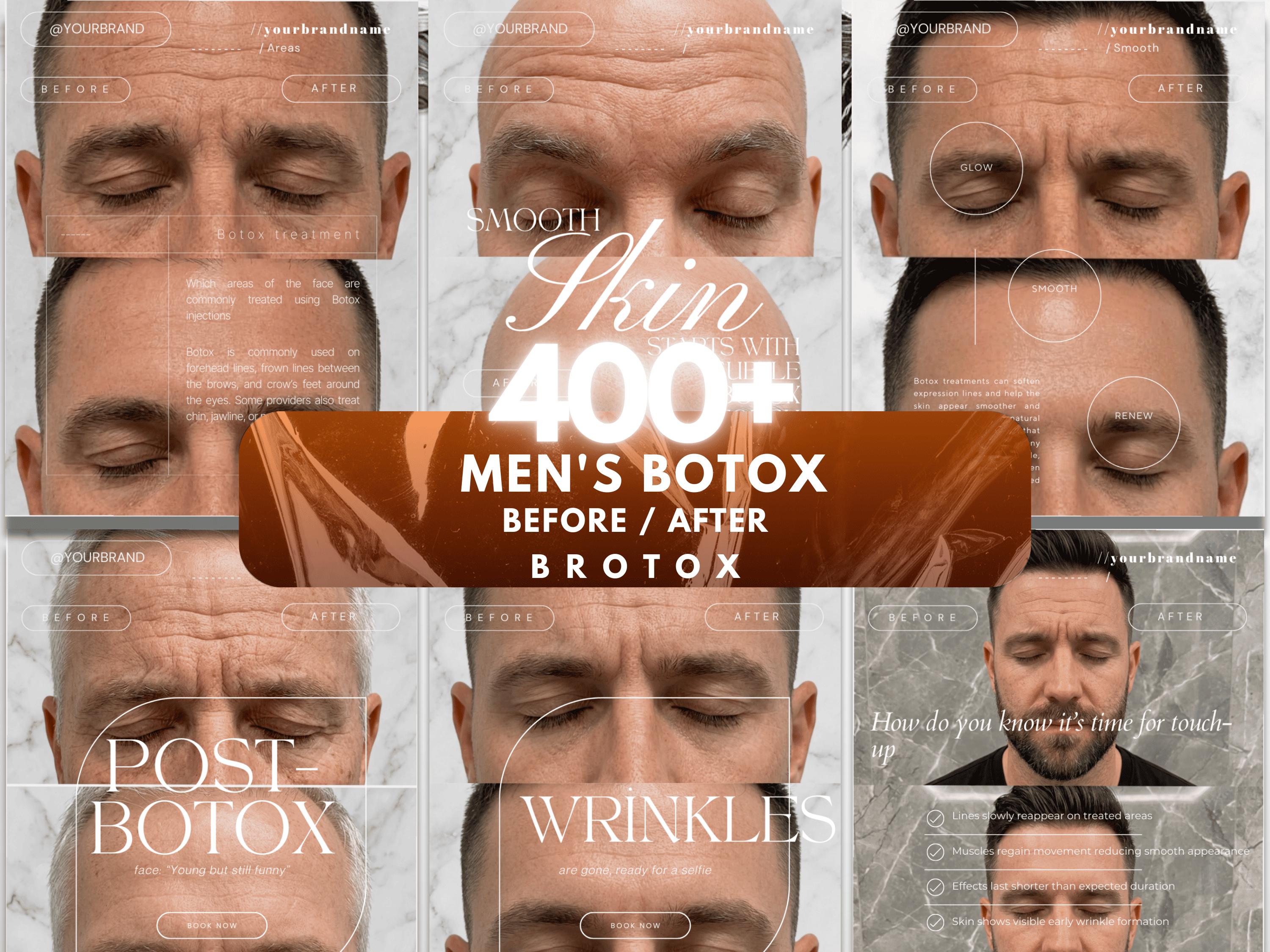 Modèles Instagram Botox pour hommes | Publications Brotox Canva modifiables pour MedSpa | Téléchargement numérique