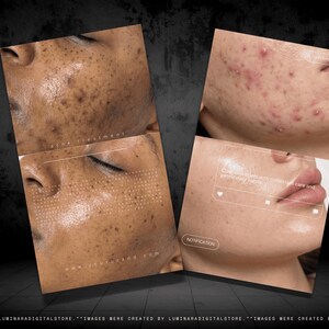 May include: A digital graphic display showing two sets of before and after skin comparison photos. The left side shows dark spot reduction, while the right side shows acne treatment results. Text overlays include acne treatment and notification labels.