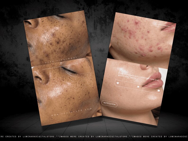 May include: A digital graphic display showing two sets of before and after skin comparison photos. The left side shows dark spot reduction, while the right side shows acne treatment results. Text overlays include acne treatment and notification labels.