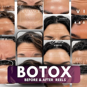 Botox Before & After Reels Templates for Instagram | Medspa Canva Editable Posts