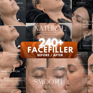 May include: A collage of before-and-after images showcasing facial filler treatments. The central image features the text "240+ FACEFILLER BEFORE / AFTER". Other text includes "NATURAL" and "SMOOTH", with details about the procedure and its effects.