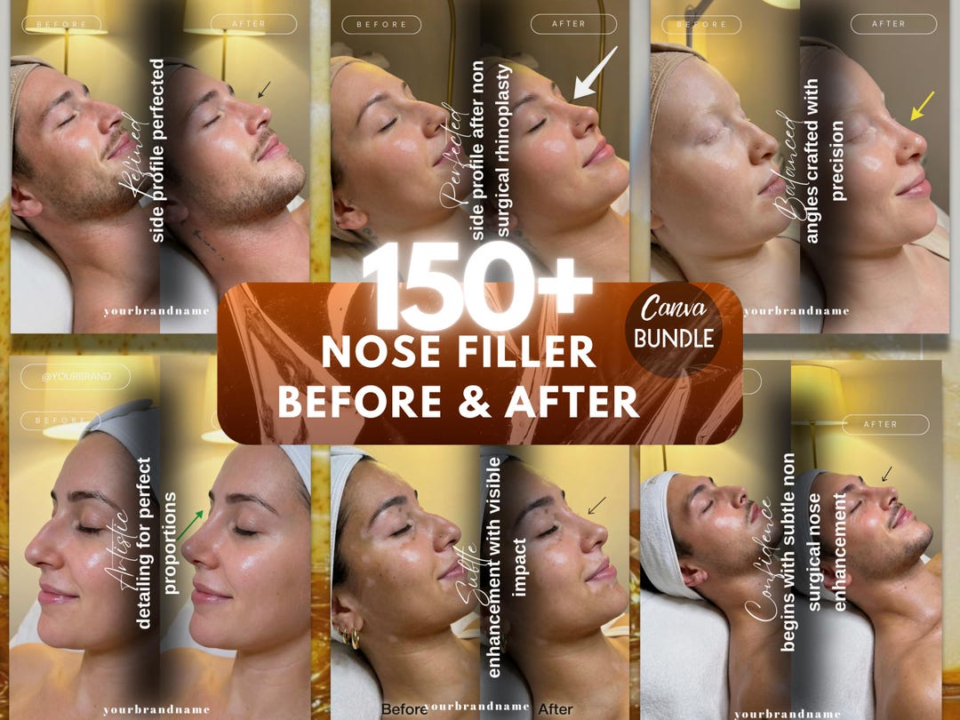 Nose Filler Canva Template | Jawline Filler Instagram Post | Aesthetic ...