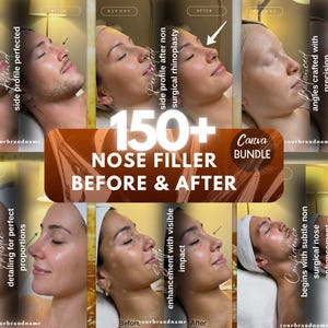 Puede incluir: Un collage que muestra imágenes de antes y después de procedimientos de relleno nasal. Las imágenes muestran perfiles laterales con superposiciones de texto que resaltan las mejoras y el texto "150+ Nose Filler Before & After" en un paquete de Canva.
