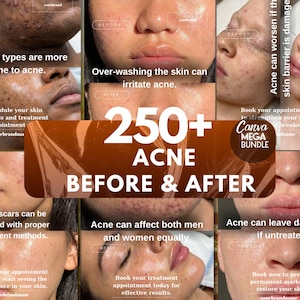 May include: A collage of images showcasing before and after results for acne treatment. The central text reads "250+ ACNE BEFORE & AFTER." Additional text highlights acne facts, such as "Oily skin types are more prone to acne" and "Acne can leave dark spots if untreated."