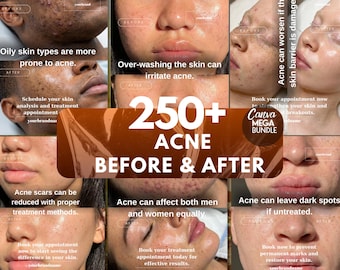 Acne Before & After Canva Template | Esthetician Posts (Digital Download)