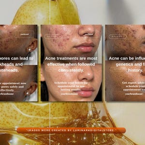 May include: A promotional image with before and after photos of skin affected by acne. The text highlights the causes of acne, the effectiveness of treatments, and the importance of genetics. The bottom of the image reads "IMAGES WERE CREATED BY LUMINARADIGITALSTORE."