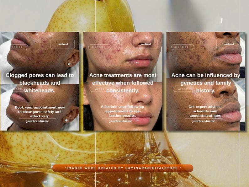 May include: A promotional image with before and after photos of skin affected by acne. The text highlights the causes of acne, the effectiveness of treatments, and the importance of genetics. The bottom of the image reads "IMAGES WERE CREATED BY LUMINARADIGITALSTORE."