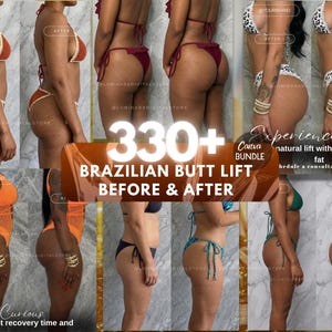 BBL Canva-sjabloon, Body Contour Post, Aesthetic Clinic-sjabloon voor sociale media, bewerkbare schoonheidsmarketing, digitale download