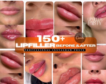 Lip filler before after post | Lip injection before and after, Skincare | Lip filler result | Facefiller Medspa social media, nurse injector