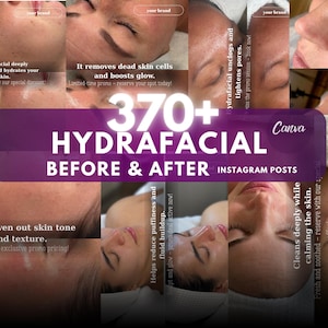 Hydrafacial Before & After Instagram Template: Skincare Promo (370+ Posts)