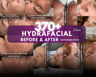 370+ Hydrafacial Instagram Templates | Med Spa Canva Posts | Skincare Marketing Kit | Editable Canva