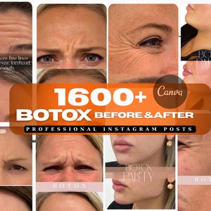 Botox Instagram Post Templates: Medspa Social Media (1600+ Canva)