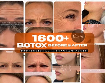 Botox before after  |  Botox Instagram posts | Skincare | Botox canva template, Medspa social media, nurse injector instagram,botox result