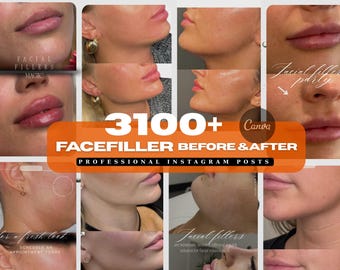 Facial Filler before after post,filler result, Dermalfiller, Lip filler,Medspa, nurse injector,Wrinkle Filler,Injectable Filler template
