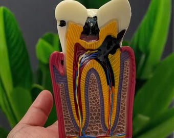 Handmade Dental Caries Tooth Decay Model 8x — Teaching Tool for Dentist Training, Dental Labs, Oral Health Education & Medical Office Decor