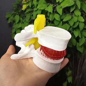 Peut inclure: Modèle imprimé en 3D d'une vertèbre humaine avec un nerf jaune et un disque rouge. La vertèbre est blanche et a une surface texturée.