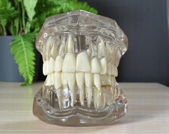 Handmade Dental Implant Bridge Anatomy Model—Demonstration Tool for Dentists, Students, Medical Training, Office Display, High-Quality Gift