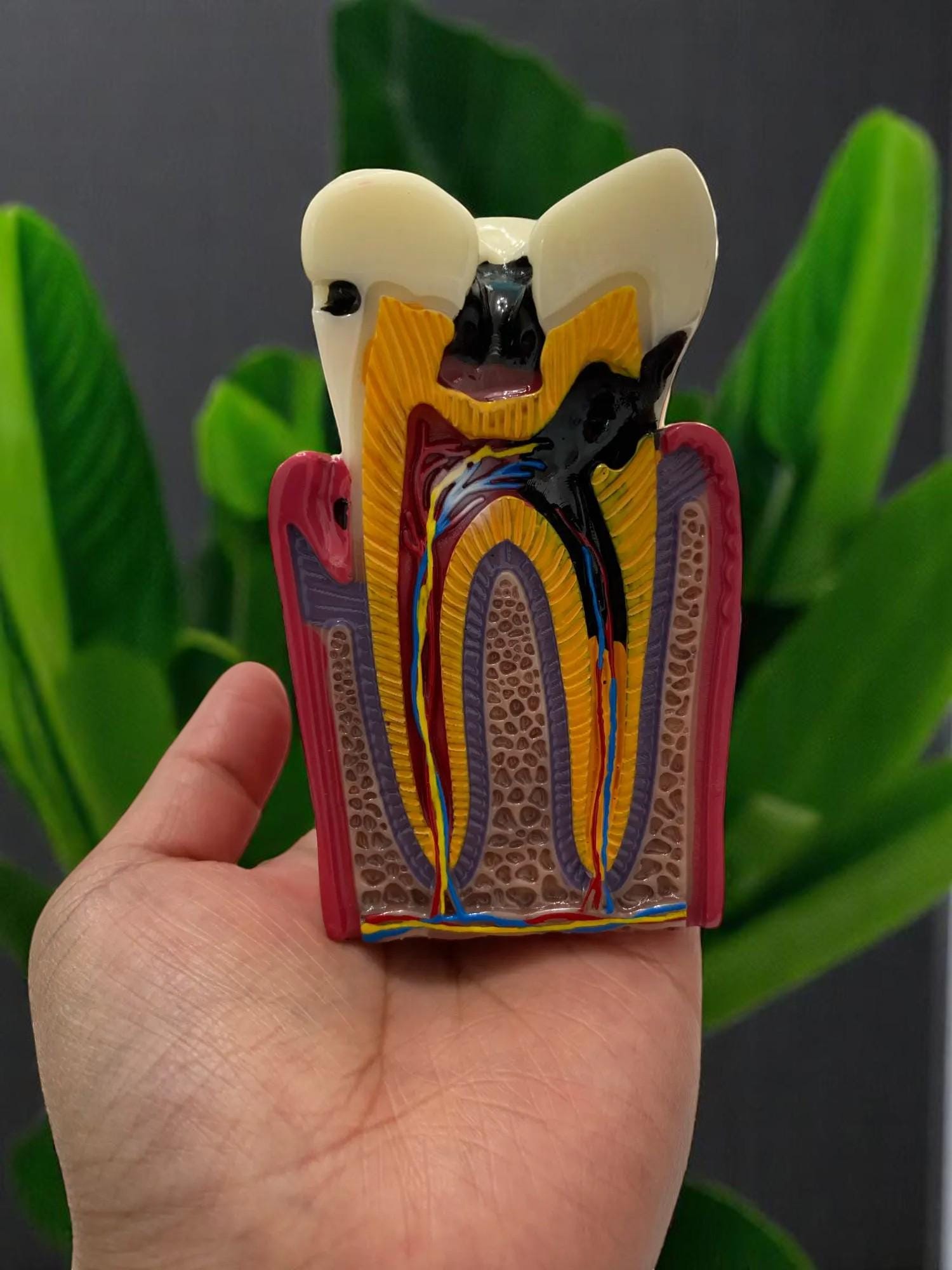 Modèle Dentaire Pédagogique - Maladie Parodontale Et Caries - Typodont - Neuf