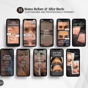 May include: Ten smartphones are arranged, each showing images and text related to Botox treatments. The screens display phrases such as "Skin Transformation" and "Subtle Changes Big Confidence". The top of the image reads "35 Botox Before & After Reels".