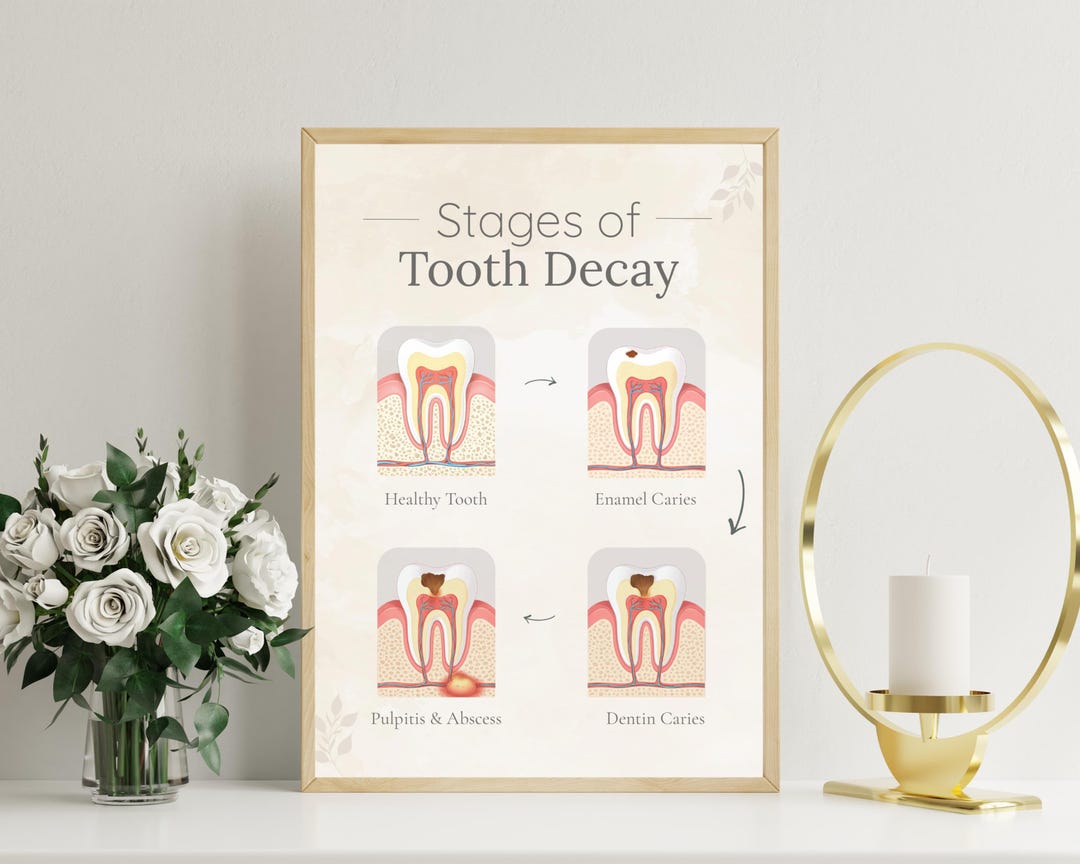 Tooth Decay Line Graph Stages of Tooth Decay Poster for Dental Office, Tooth Decay Chart ...