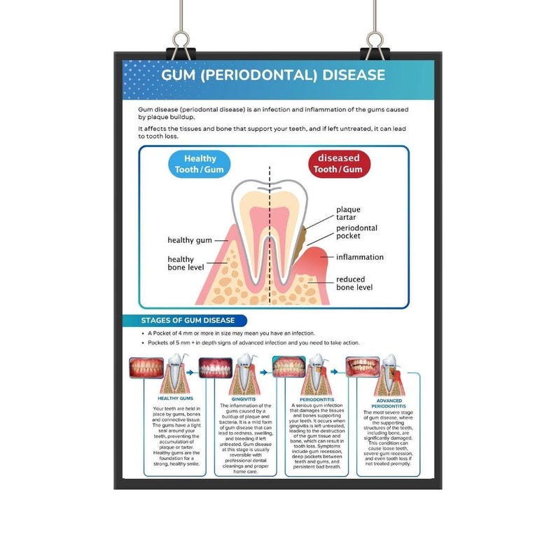 Periodontal Disease Dental Poster, Gum Health Patient Education Chart ...