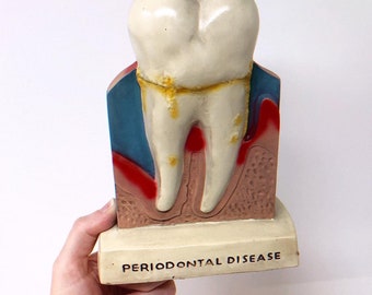 SALE! Big Tooth Model Advertising Dental Decay Molar for Dentist Office or Oddities Collection