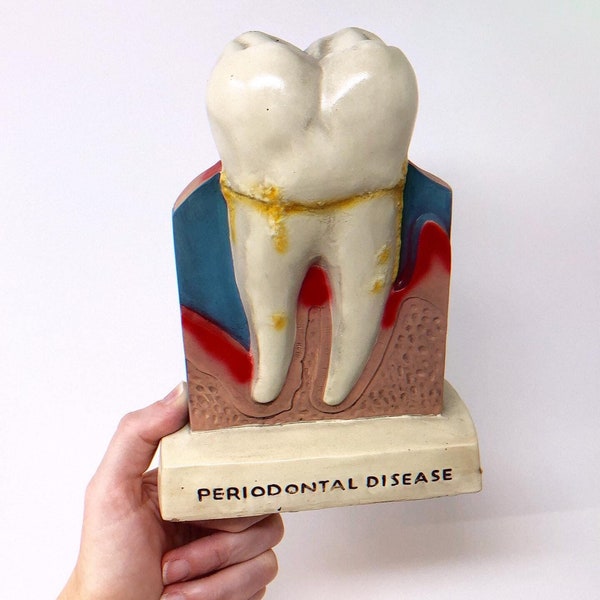 SALE! Big Tooth Model Advertising Dental Decay Molar for Dentist Office or Oddities Collection