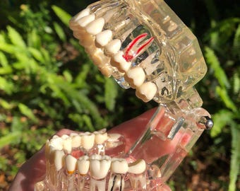 Clear Dental Model for Educational or Display Purposes - Human Dental Disease, Tooth Decay, Impacted Wisdom Teeth - Cosplay or Movie Prop