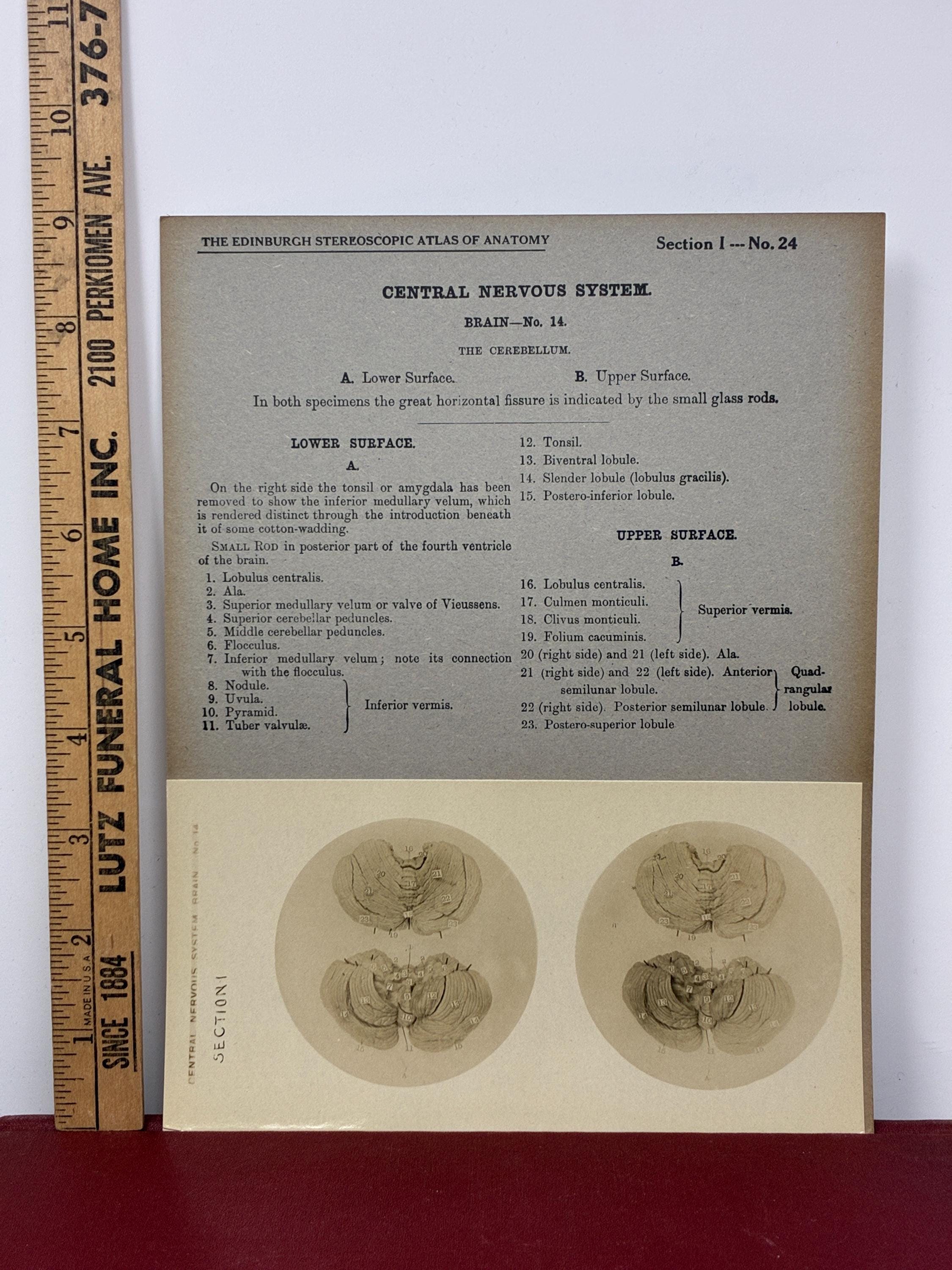 1905 Human Brain Dissection Medical Stereoview Card - Central Nervous ...