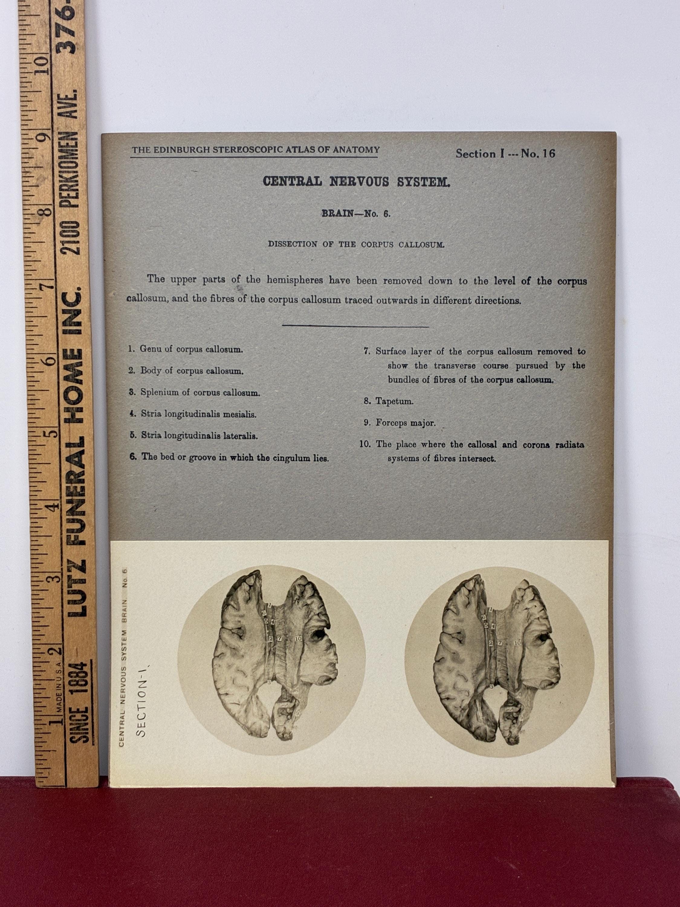 1905 Human Brain Dissection Medical Stereoview Card - Central Nervous ...