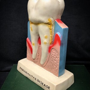 Big Tooth Model Advertising Dental Decay Molar - Dentist Office ...