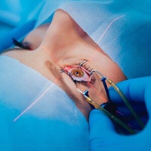 May include: Close-up of a person's eye during an eye surgery procedure. A surgical tool is being used to hold the eyelid open, and a laser beam is visible.