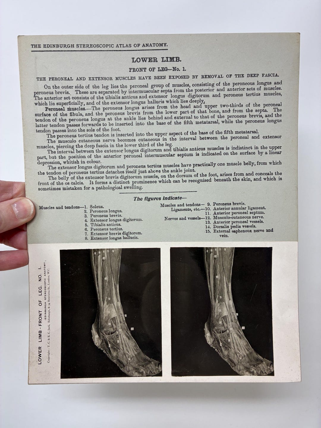 1905 Human Leg & Foot Dissection Medical Stereoview Card Front - Lower ...