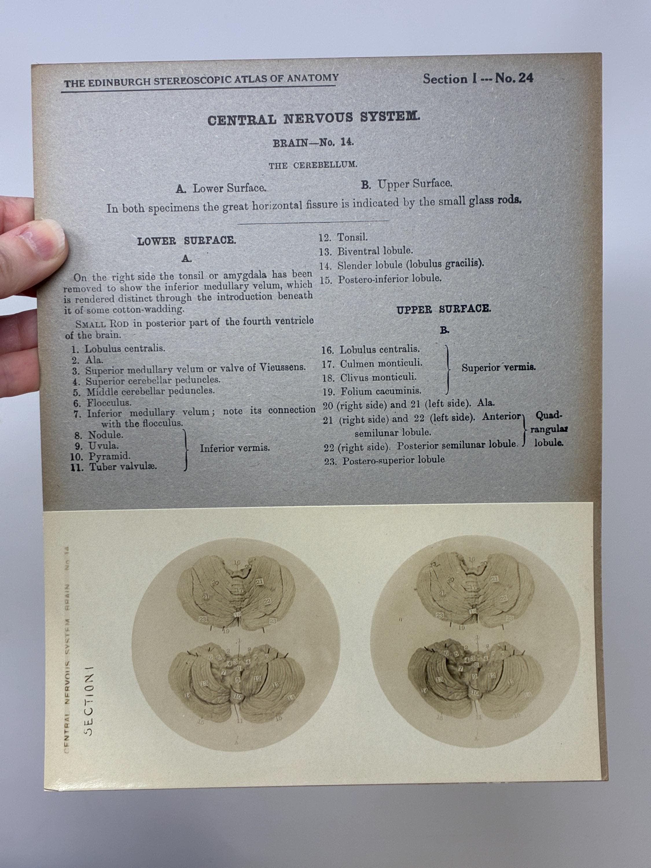 1905 Human Brain Dissection Medical Stereoview Card - Central Nervous ...