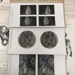 ULTIMO! Scheda stereoscopica medica del 1905 con dissezione del cervello umano - Sistema nervoso centrale - Cosplay, oggetti di scena cinematografici, curiosità, collezione medica