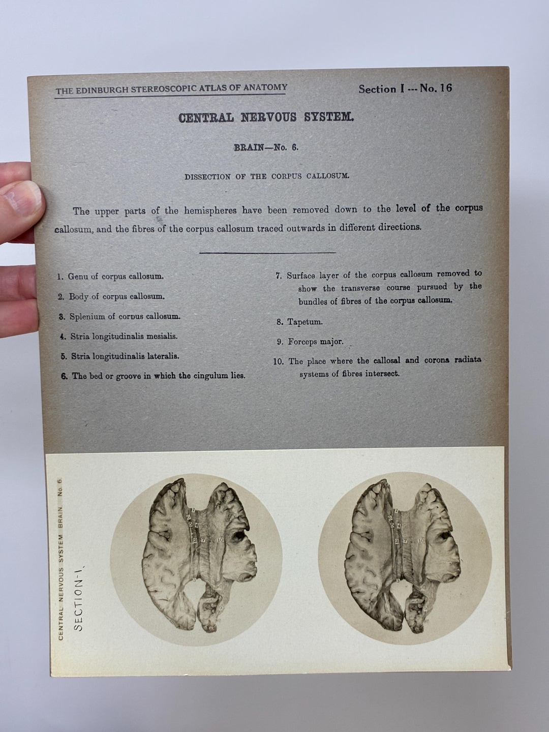 1905 Human Brain Dissection Medical Stereoview Card - Central Nervous ...