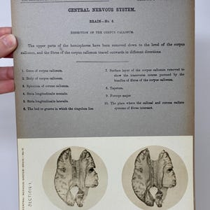 1905 Human Brain Dissection Medical Stereoview Card - Central Nervous System - Brain Number 6