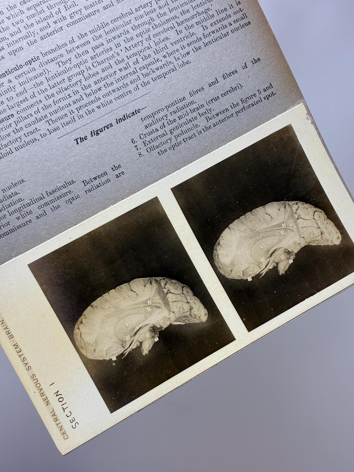 1905 Human Brain Dissection Medical Stereoview Card - Central Nervous ...
