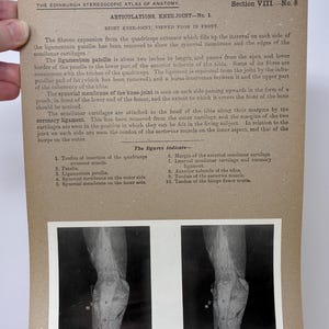 May include: Anatomy illustration from the Edinburgh Stereoscopic Atlas of Anatomy. The image shows a detailed view of a knee joint, with labels indicating various anatomical features. The text describes the ligamentum patellae, about two inches in length.