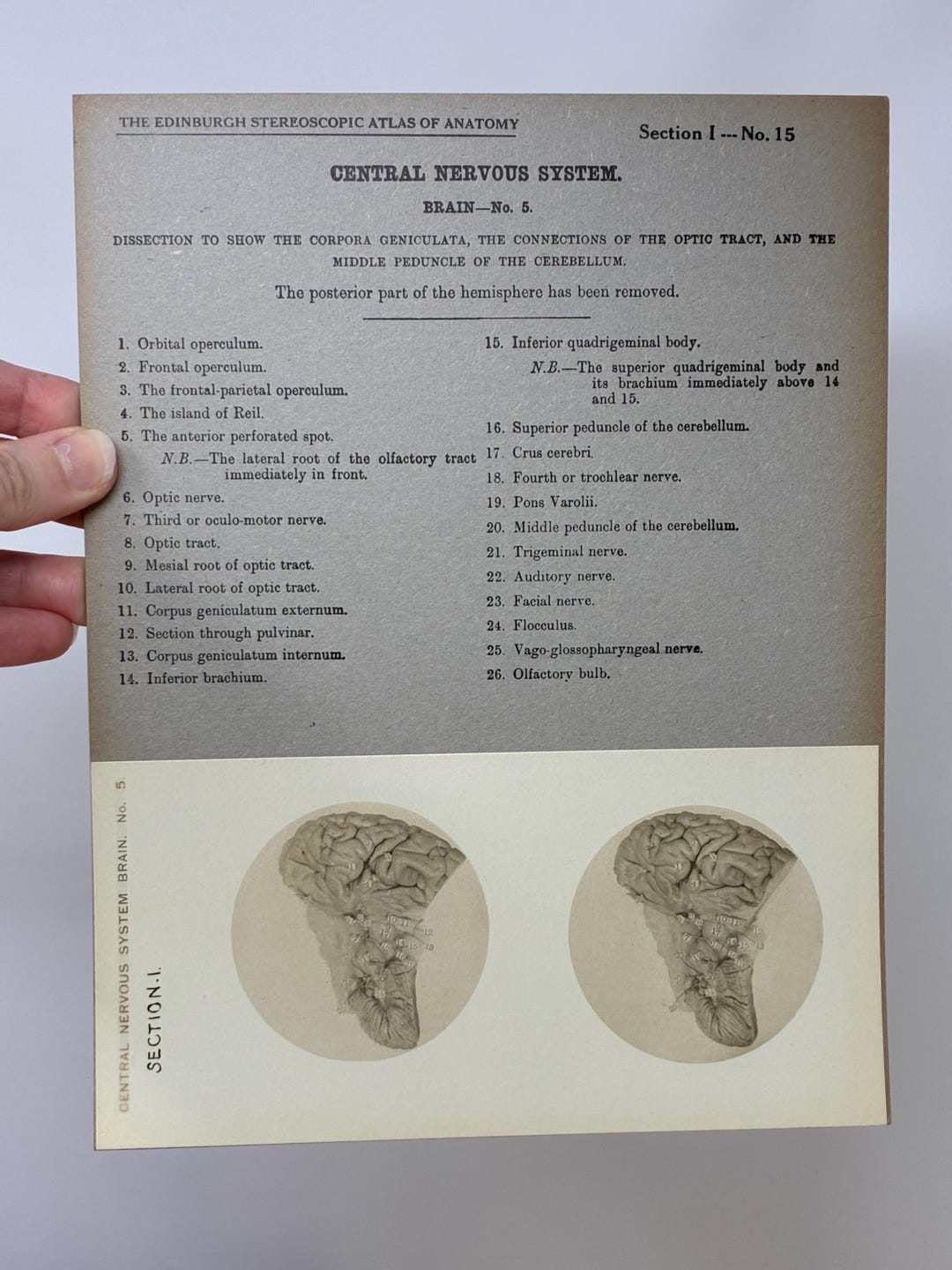 1905 Human Brain Dissection Medical Stereoview Card - Central Nervous ...