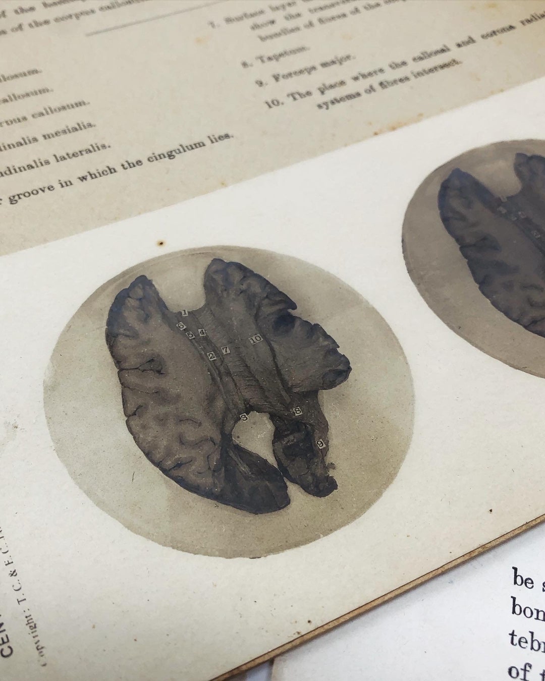 1905 Human Brain Dissection Medical Stereoview Card - Central Nervous ...