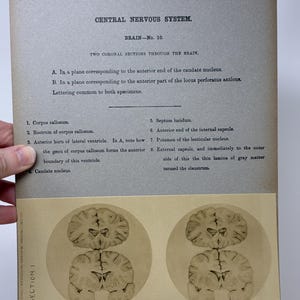 1905 Human Brain Dissection Medical Stereoview Card - Central Nervous System - Brain Number 10