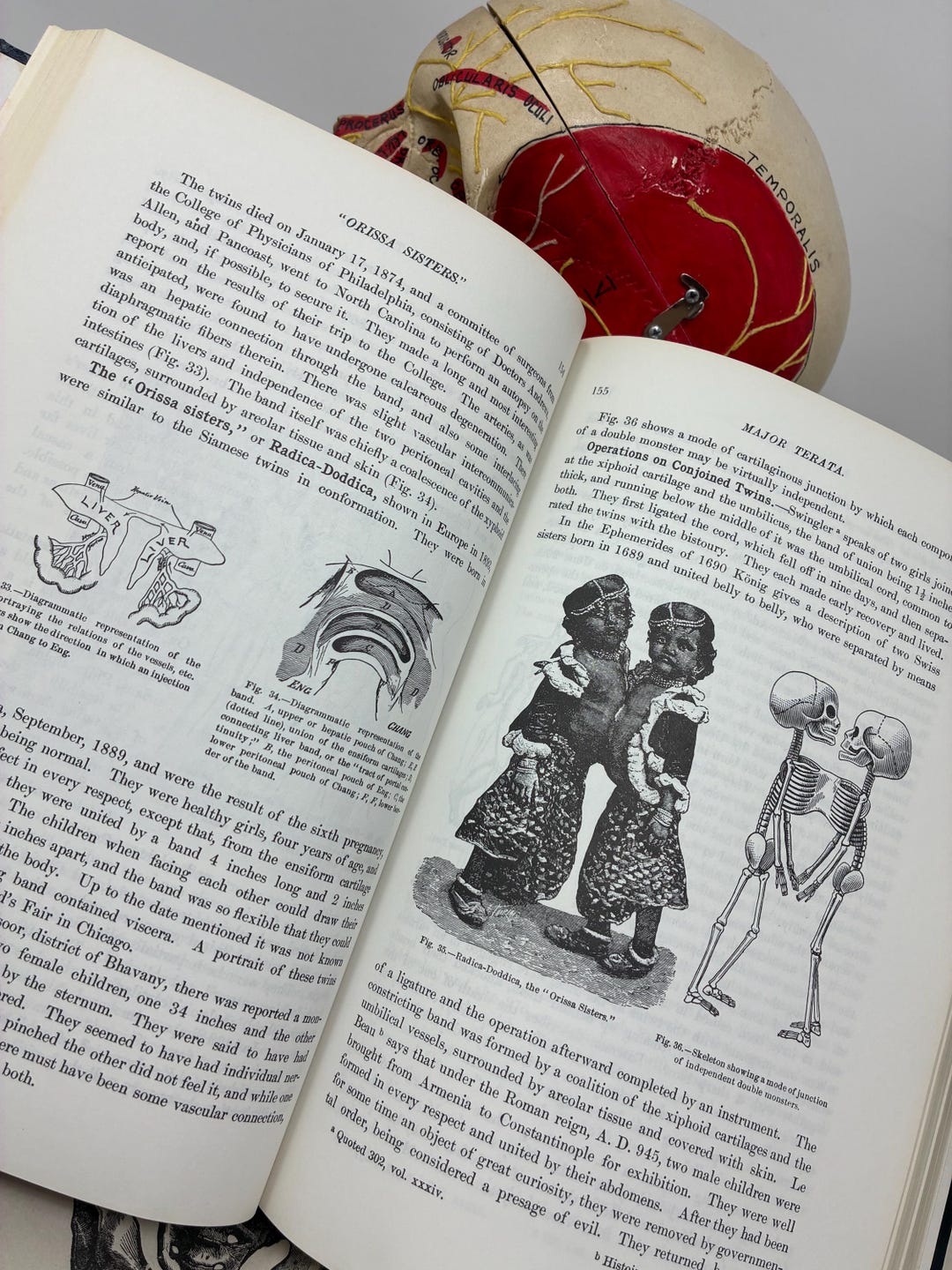 1980s Medical Encyclopedia of Rare Abnormalities Birth Defects - For Cosplay, Movie Prop, Oddities, Medical Book Collection