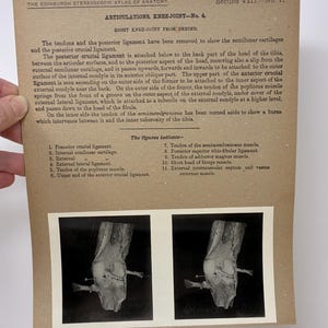 May include: Anatomy illustration from the Edinburgh Stereoscopic Atlas of Anatomy. The image shows a detailed view of a knee joint from behind, with labels and descriptions. The text includes anatomical terms and references to ligaments and muscles.